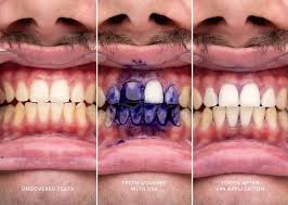 Hismile V34 Corrector Dental Morado Original | Dientes Más Blancos al Instante